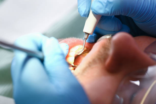 Best Emergency Wisdom Teeth Removal in Shawnee Hills, OH